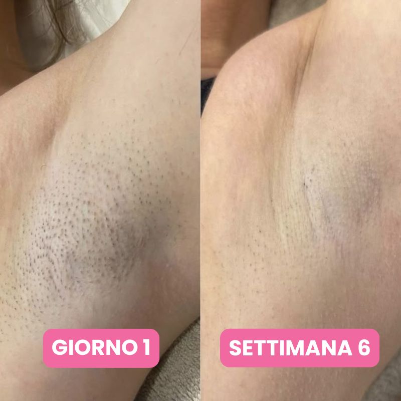 Siero anti-ricrescita peli: Non serve più radersi ogni due giorni