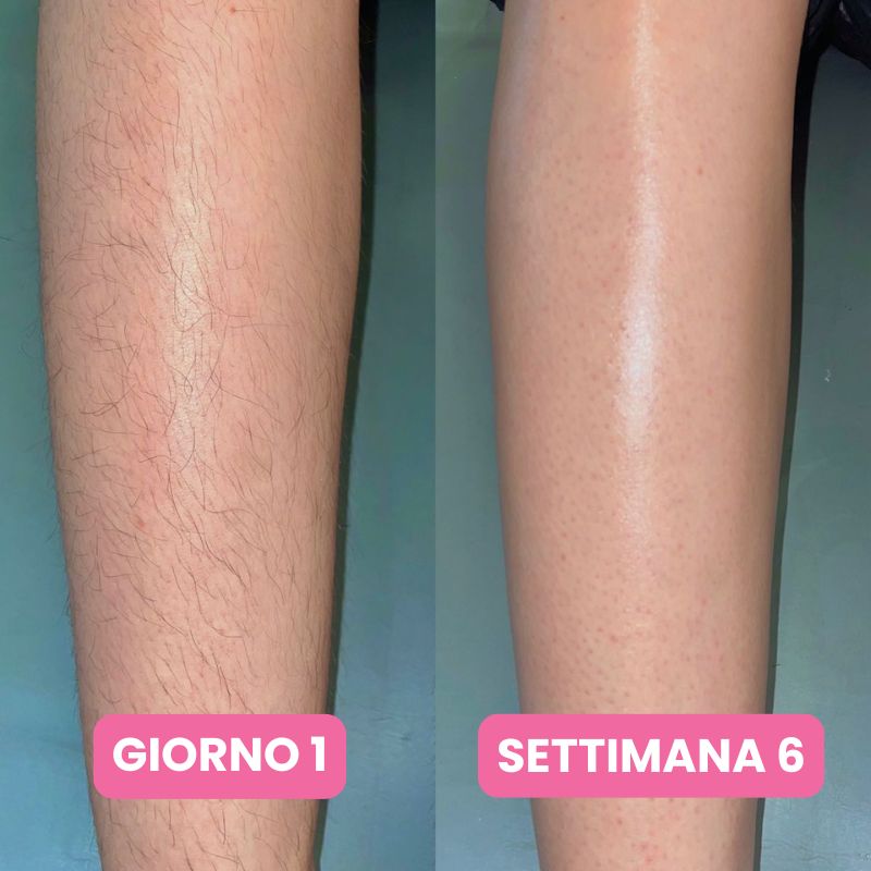 Siero anti-ricrescita peli: Non serve più radersi ogni due giorni