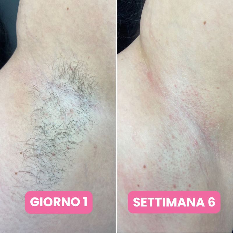 Siero anti-ricrescita peli: Non serve più radersi ogni due giorni