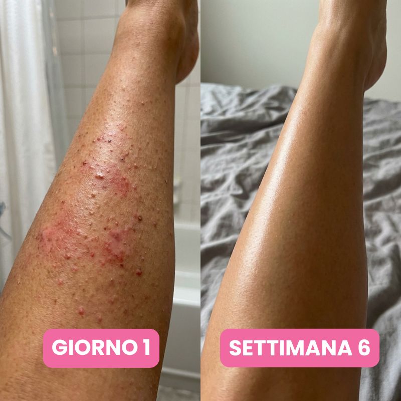 Siero anti-ricrescita peli: Non serve più radersi ogni due giorni