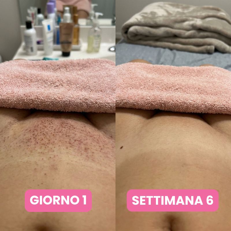 Siero anti-ricrescita peli: Non serve più radersi ogni due giorni