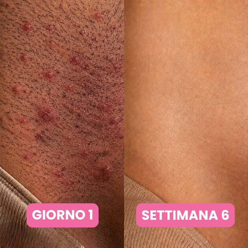 Siero anti-ricrescita peli: Non serve più radersi ogni due giorni